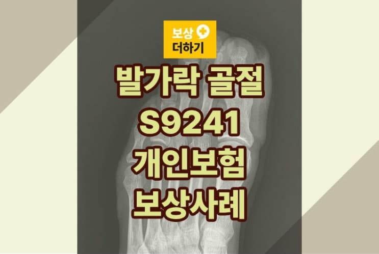 업무 중 사고로 발가락 골절 S9241 개인보험에서도 보상받아