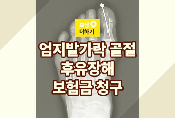 1족지 엄지발가락 골절 수술 - 후유장해 보상 금액은?