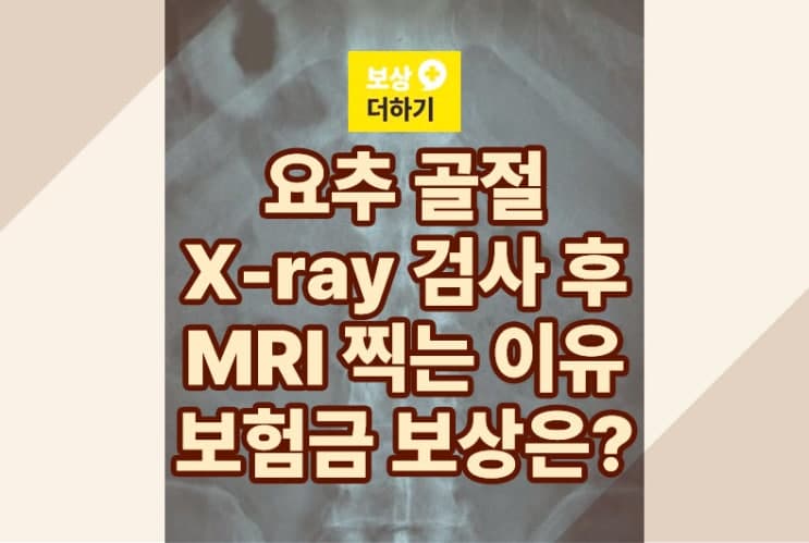 요추골절 엑스레이 검사로 충분? 보험금 보상은? (사례)