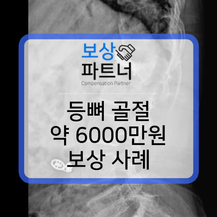 등뼈골절 척추1번 버스내사고 실제 보상 사례