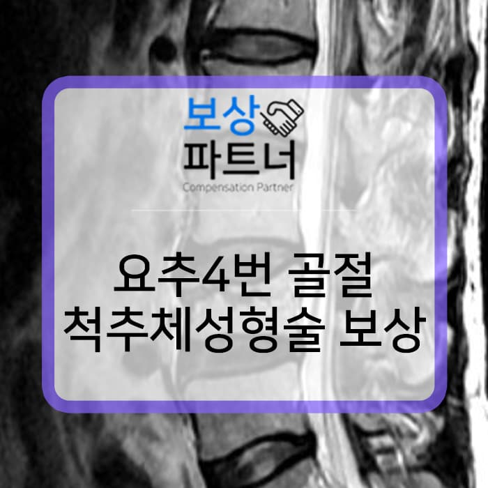 경피적 척추성형술(vertebroplasty) 받은 허리뼈 골절 보상 사레