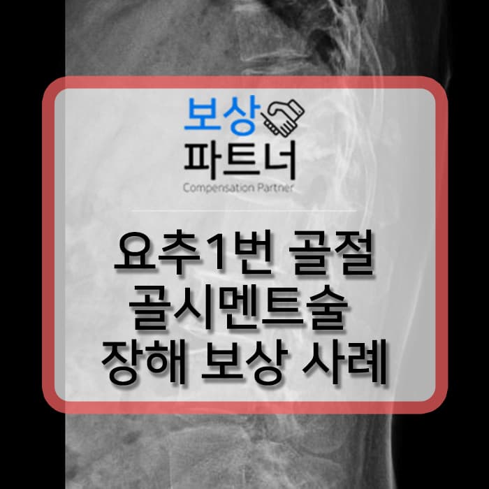 골시멘트술 받은 요추1번 압박골절, 후유증 없어도 보험에서 후유장해 알아봐야 하는 이유