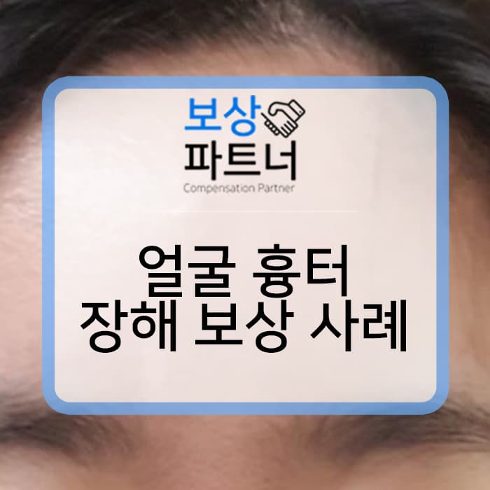 사고로 생긴 얼굴 흉터 s018 피부봉합, 반흔교정술에도 흉터 남아있다면 장해보험금 받으세요.