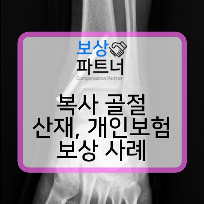 복사 골절, 발목 S82820 산재 약 1,500만 원 보상, 개인보험 900만원 보상 사례
