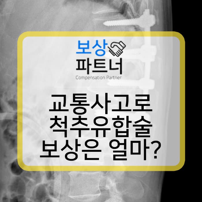 방출성 골절로 척추 유합술 (spinal fusion) 받아 합의금 7,400만 원, 개인보험 3,800만 원 보상 사례