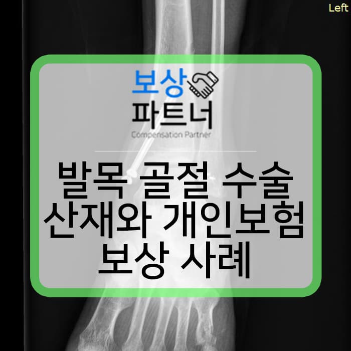 출근 중 교통사고 발목 골절 수술 산재 보상금과 개인보험 장해 청구 사례