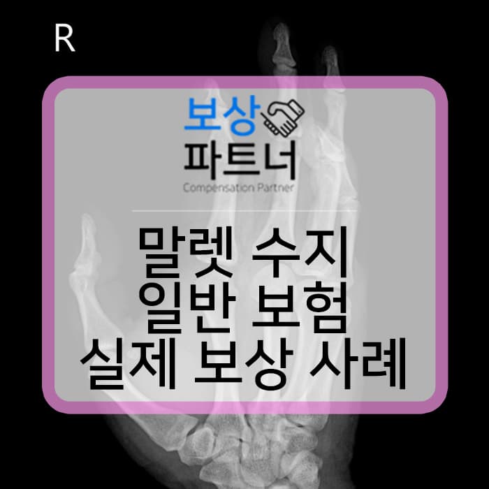 손가락 말렛핑거(mallet finger), 망치수지 일반 생명보험, 손해보험 장해 보상 사례