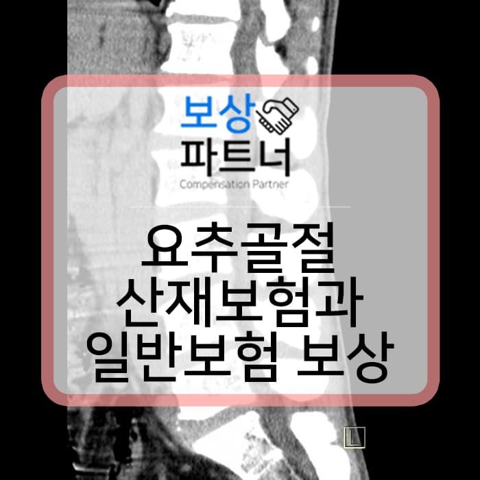 요추1번 요추2번 요추3번 척추골절 산재장해등급 얼마? 실제 보상사례 보기!