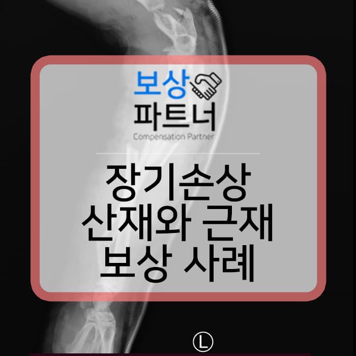 장기 손상 산재 장해등급 3급 과 근재보험 1억 3천만원 보상 사례