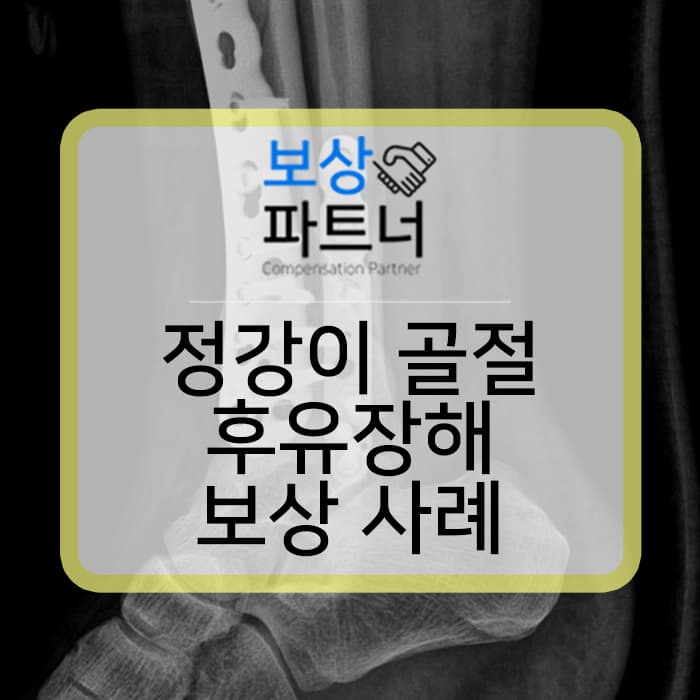 정강이뼈 골절, 정강이 골절, 경골(tibia) 골절 후유증, 후유 장해 보상 사례