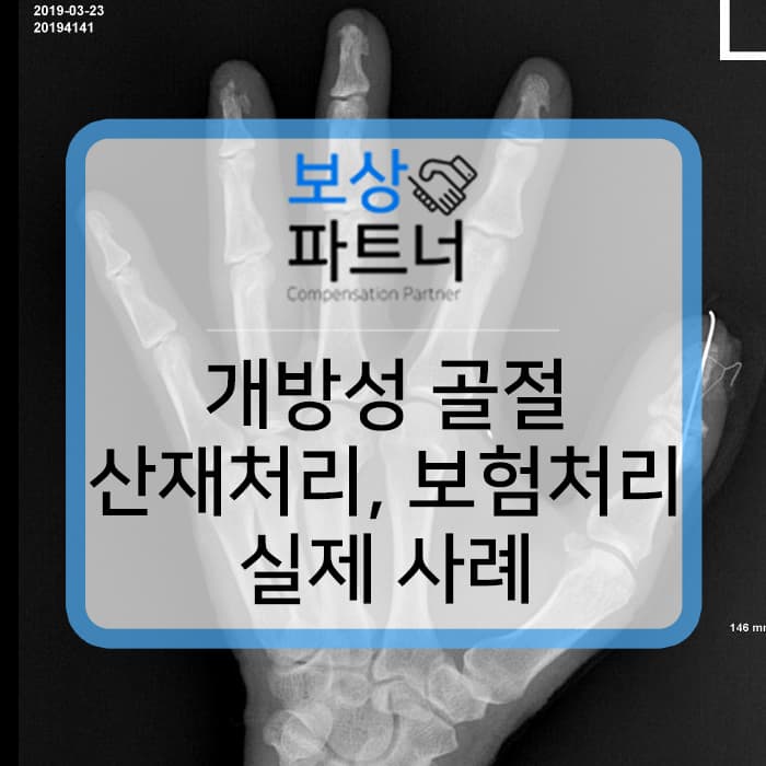 손가락 개방성 골절 산재 보상금과 일반 생손 보험 후유 장해 보상 사례