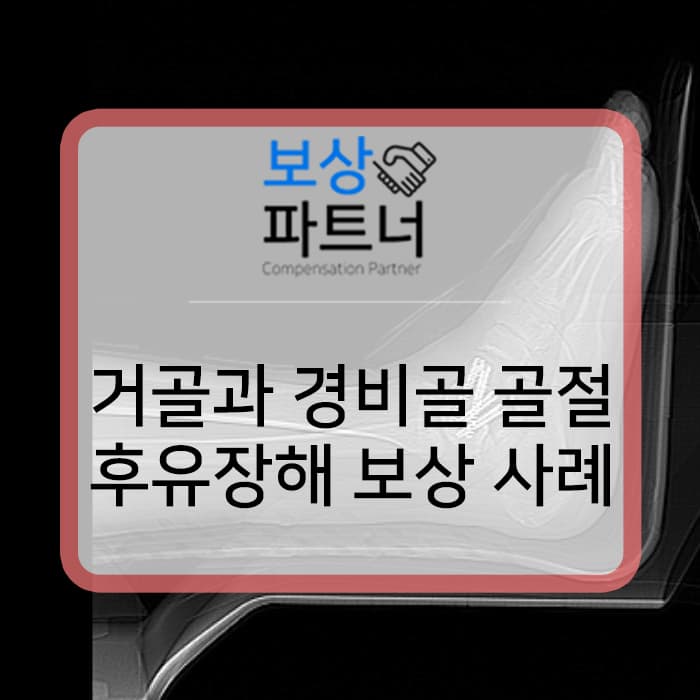 거골 (talus) 골절 과 경비골 (distal tibiofibular) 골절 생손보험 후유장해 보상 성공 사례