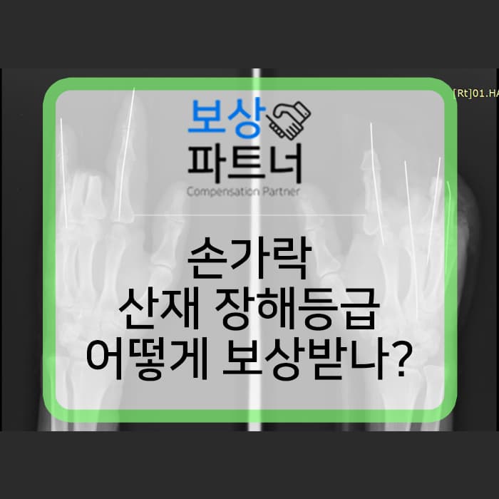 손가락 으깸손상 (압궤손상) S678 산재장해등급 보상은 어떻게?