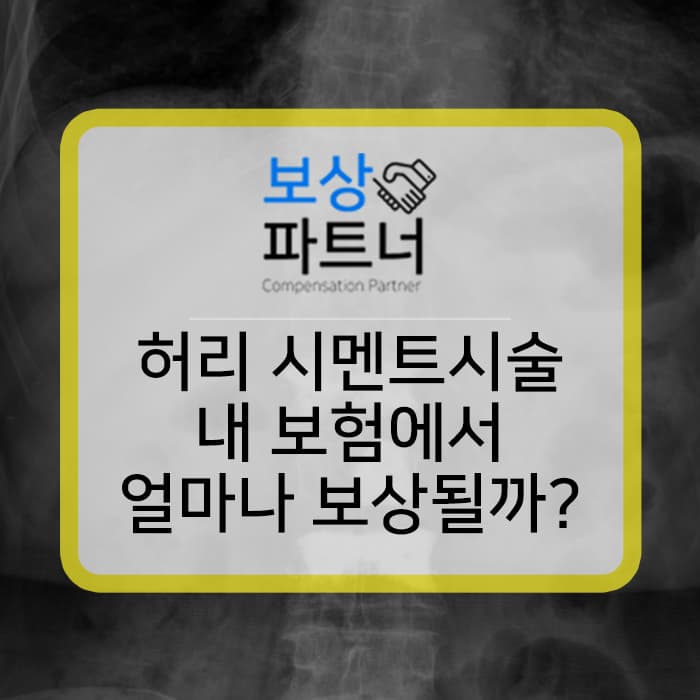 허리 시멘트시술 내 보험에서 최대 보상받는 방법은?
