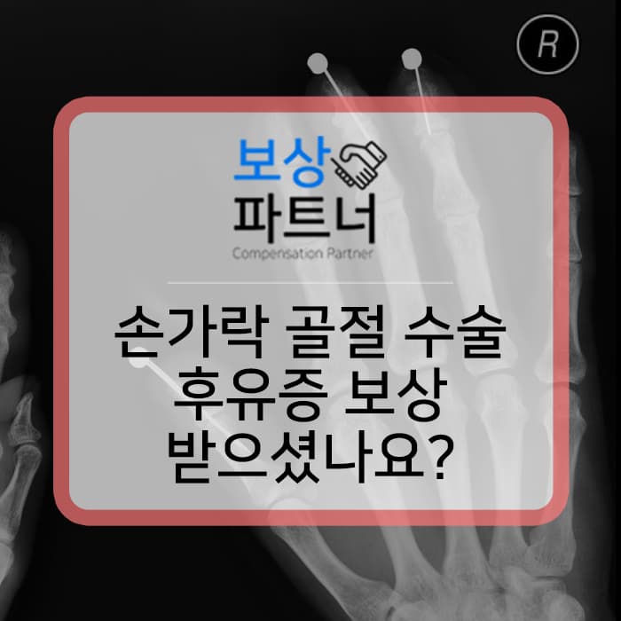 손가락골절수술 후 재활치료 중이신가요? 장해 보상 알아보세요!