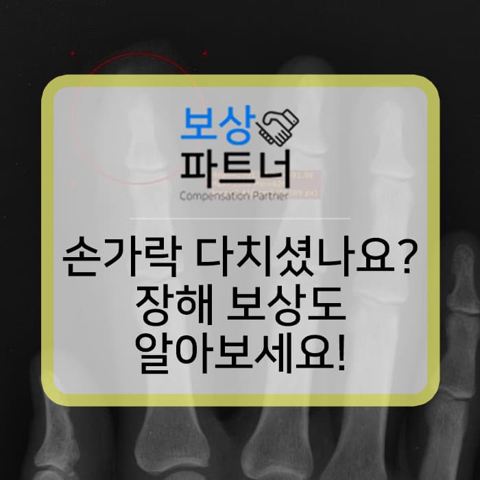 손가락골절 당했다면 후유증 보상도 알아보세요~