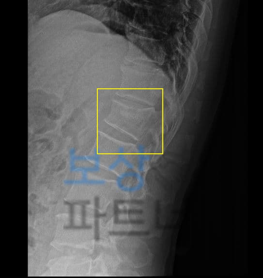 척추 1번 골절 비수술 보존치료, 후유장해 잔존했을 수 있습니다.