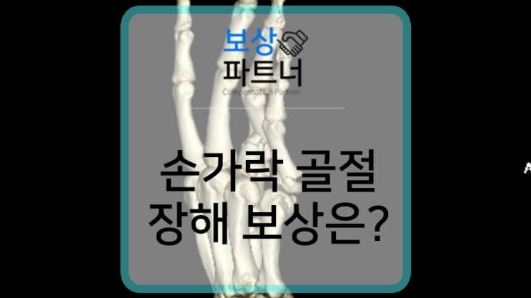 손가락 장해 20% 지급률 후유장애보험금 보상 사례