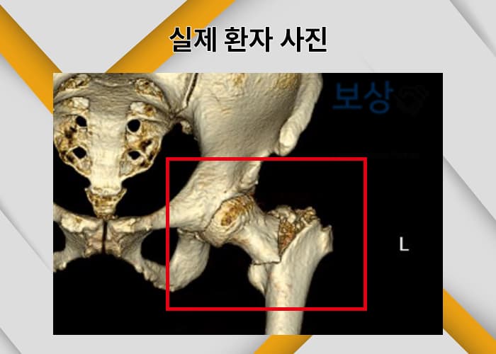 고관절 골절 수술후 1,000만 원 후유장애보험금 보상 사례