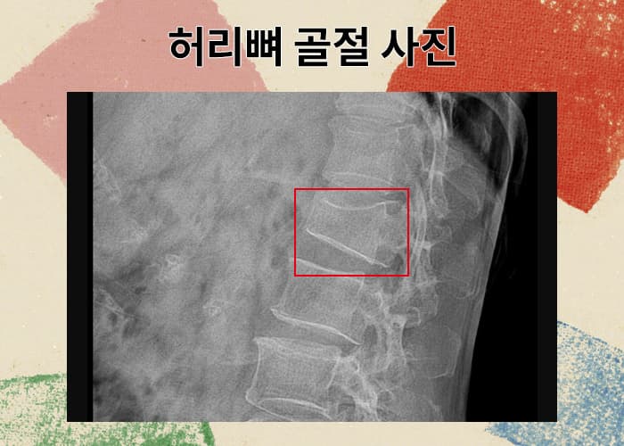 허리뼈 골절, 제대로 보상받으려면 어떻게 해야할까?
