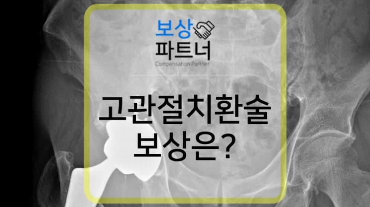 고관절치환술, 놓치고 있는 보상은 없을까요?