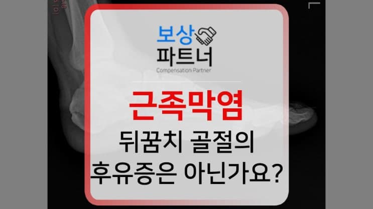 근족막염, 종골 골절 수술 받은 적 있다면 받아야 할 보상은?