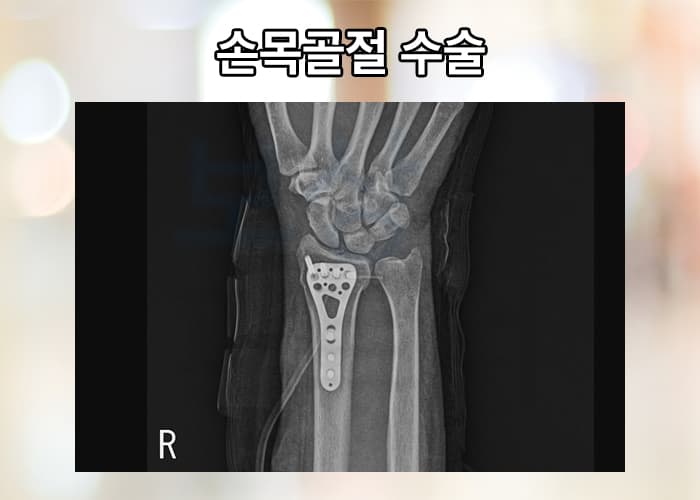 손목골절수술후재활 😥 쉽지 않다면 알아봐야 할 후유장애보험금!