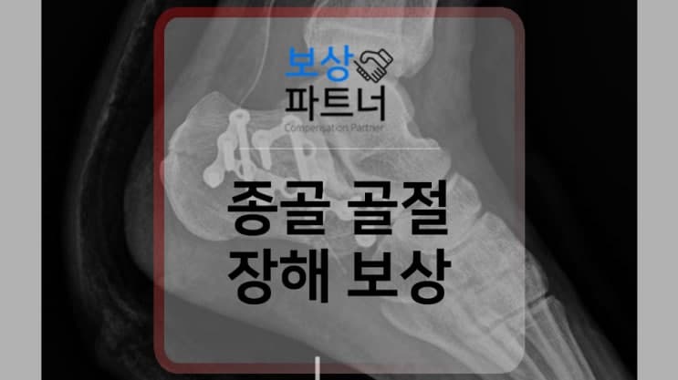 CALCANEOUS 종골의 골절 진단받았다면 고려해야 할 후유장해보험금