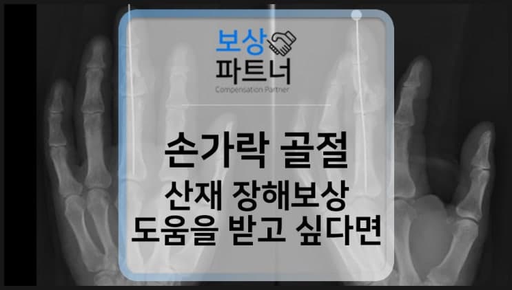 손가락 골절, 산재 장해등급 보상금 이만큼이나 받았어요.
