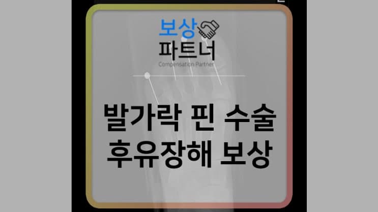 발가락 핀 수술, 받을 수 있는 보상에 대하여