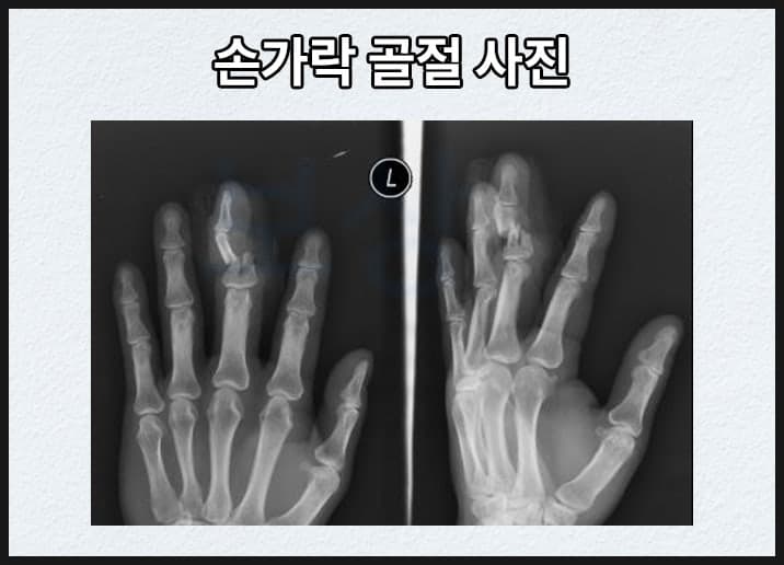 손가락 장해 판정 기준에 대하여