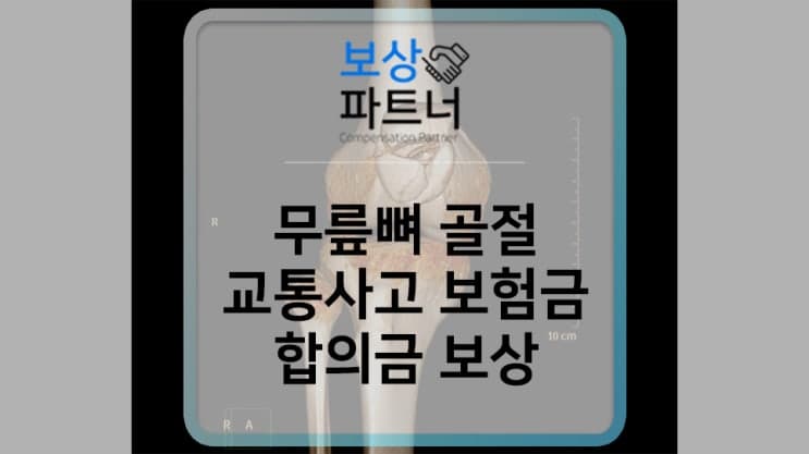 무릎뼈 슬개골 골절 수술 후 교통사고 보험금, 합의금 보상 사례