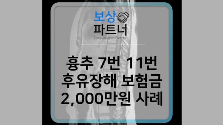 흉추 7번,11번(T7 T11) 압박골절 후유장해 보험금 사례